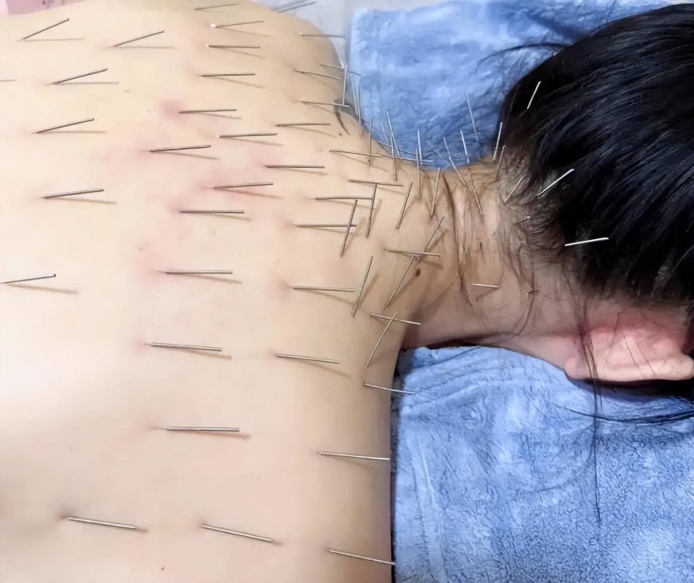 陈乔恩针灸保养惊呆网友,百根针扎遍全身,抗衰拼劲十足!