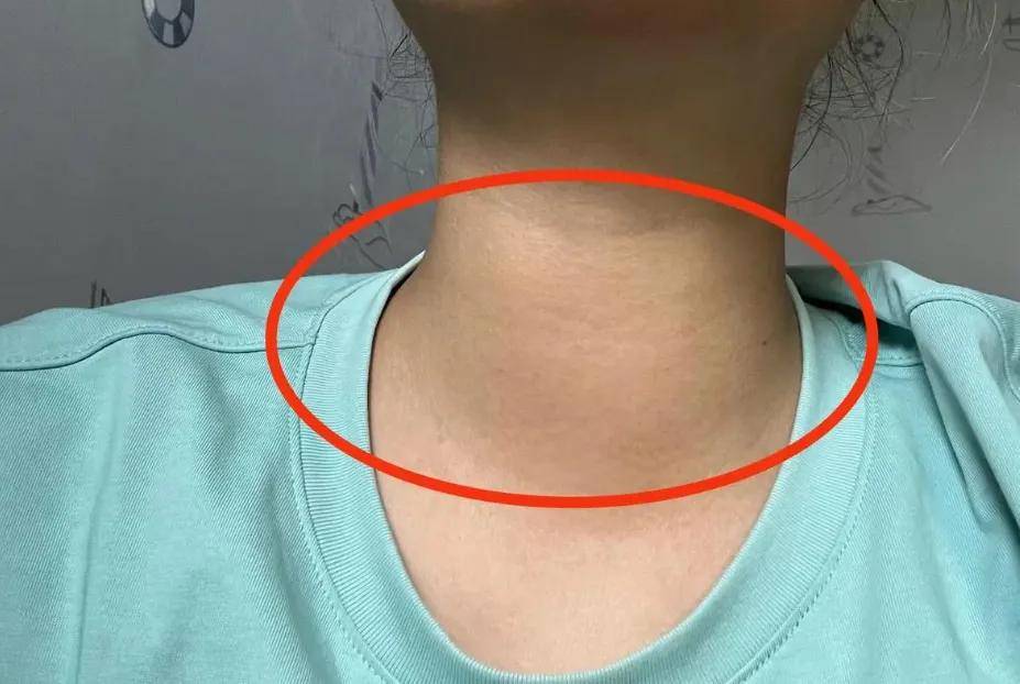 甲状腺_患者_口服药物