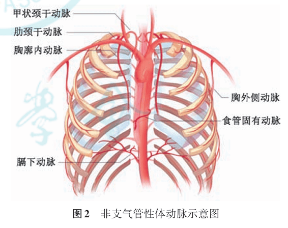 徐州七院成功实施支气管动脉拦截术,患者大咯血获救!