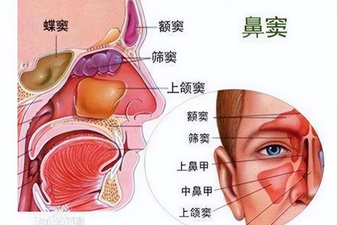 真菌性蝶窦炎感染早期症状不典型,常被误诊为普通头痛或神经性疾病