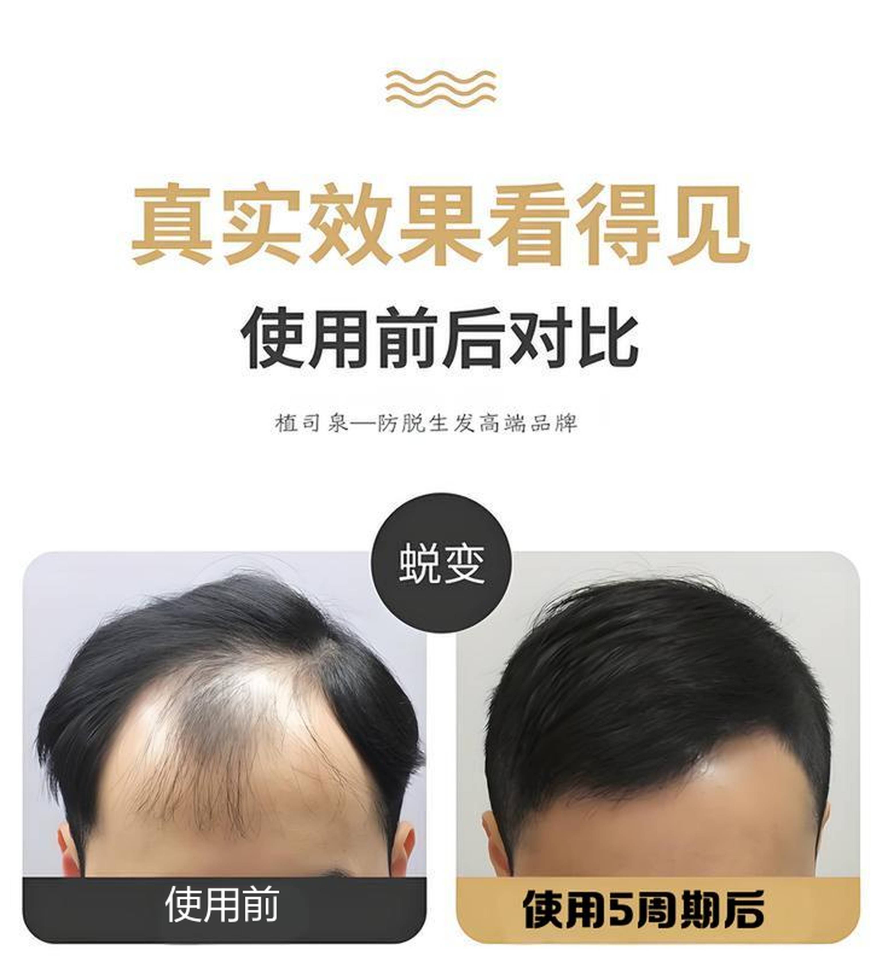 短短几个月脱发问题就解决了他精心护理发质越来越好头油头痒等