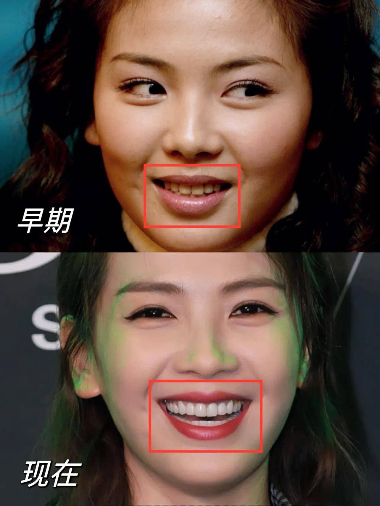 在变美这条路上刘涛也吃了不少的苦啊扎心的是钱花了苦吃了也没美