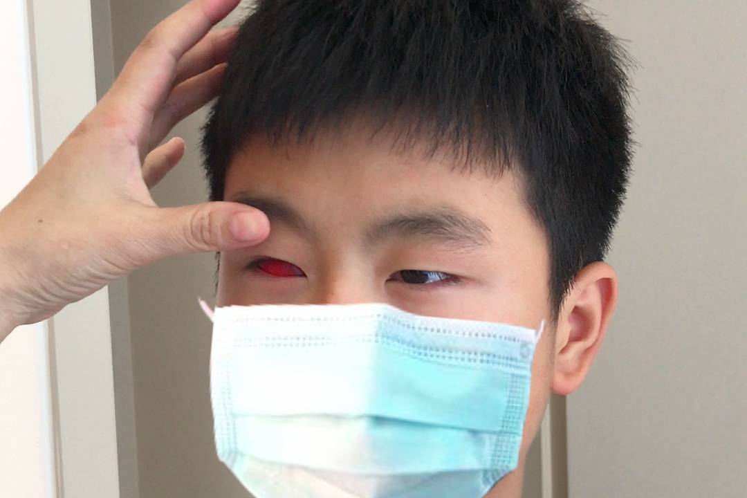 12岁单眼失明小男孩 眼球萎缩后 勇敢安装了一只假眼睛