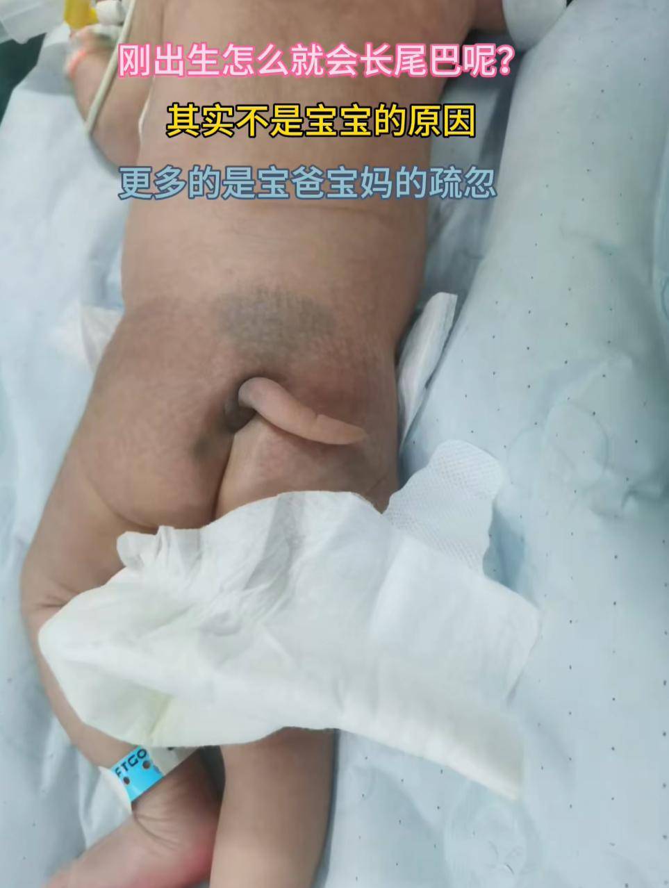 刚出生怎么就会长尾巴呢？其实不是宝宝的原因,更多的是宝爸宝妈的疏忽