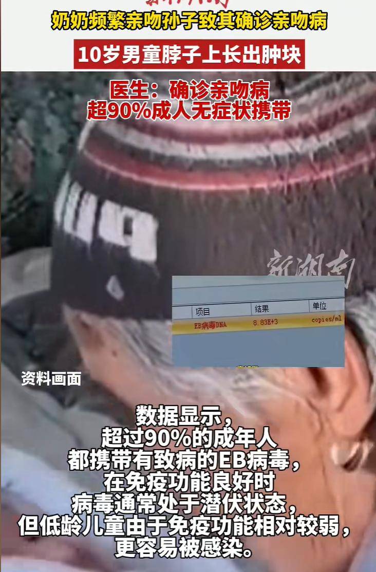 奶奶频繁亲吻孩子致其确诊亲吻病,导致10岁男孩脖子长肿块