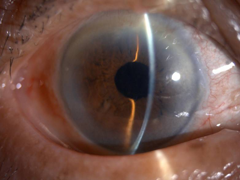  从术前近乎无视力到术后视力0.6，佛山爱尔眼科助八旬老人驱散白内障阴霾(图3)