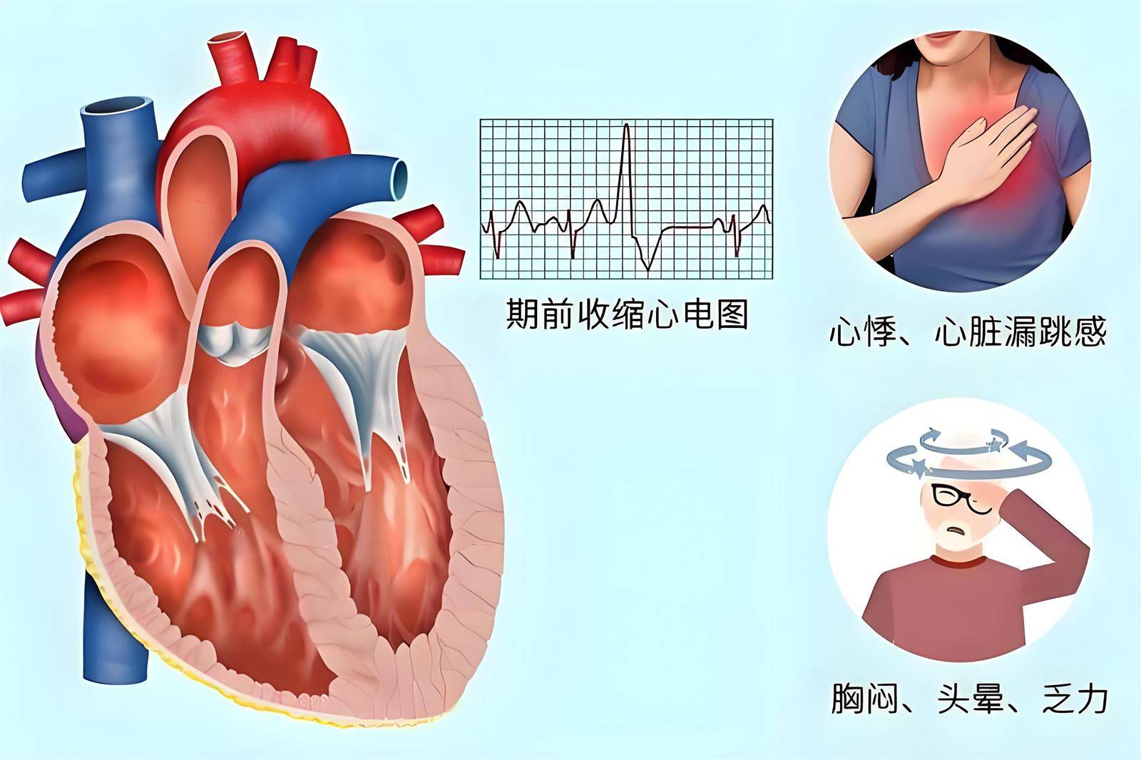 黄力医生：早搏是什么意思