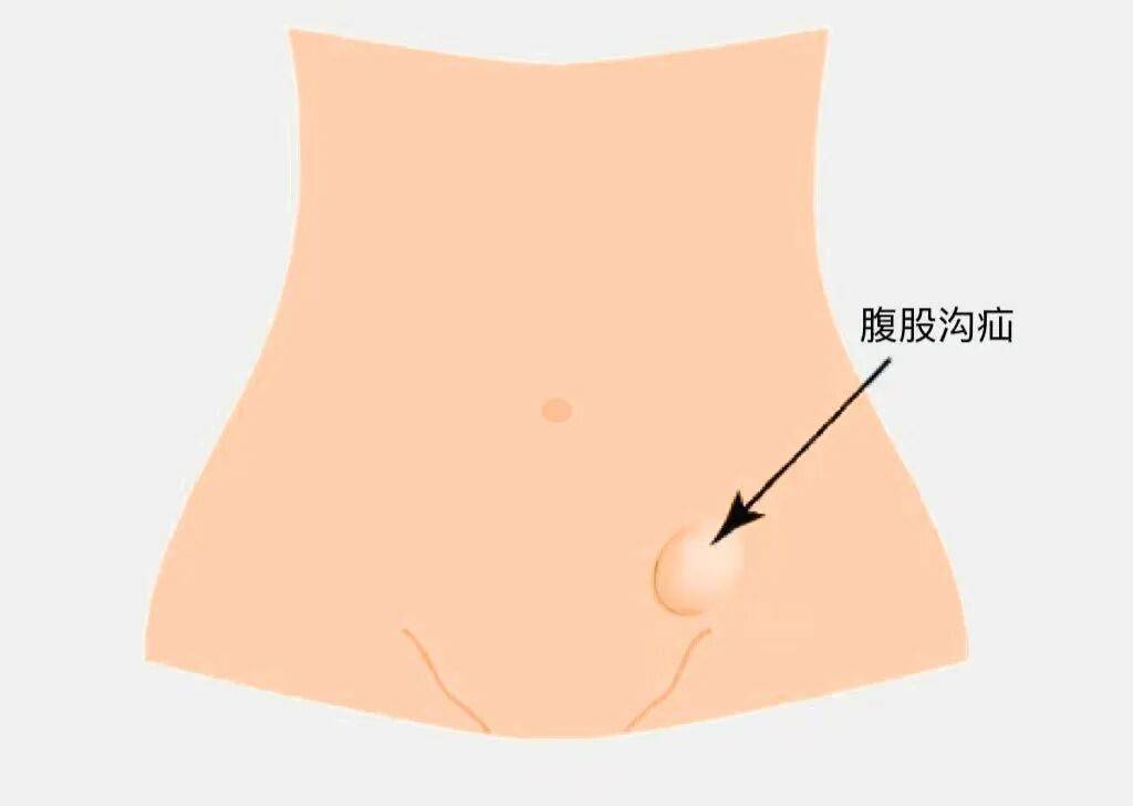 不懂就问：腹股沟疝气，是一种气体吗？