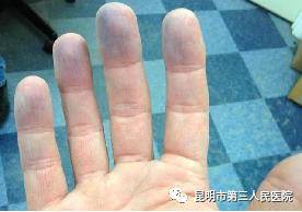 嘴唇发紫就是心脏不好吗？