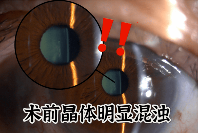 佛山爱尔眼科成功为八旬老人实施飞秒激光白内障联合三焦点晶体手术，术后视力达1.0(图2)