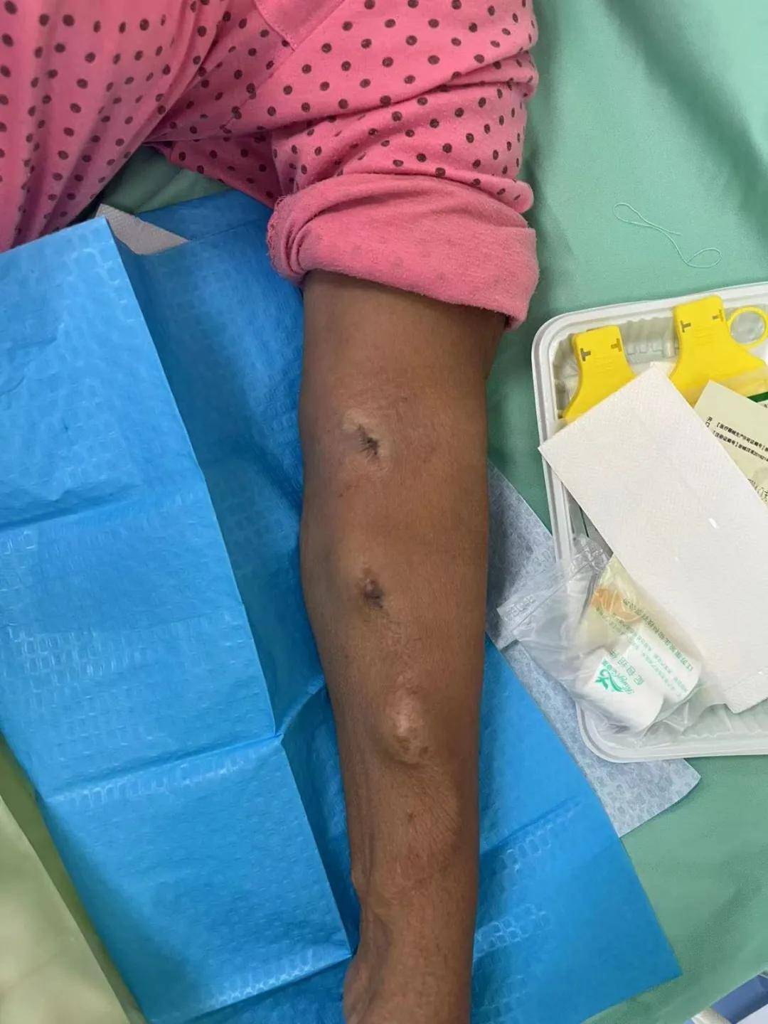 长期透析血管条件越来越差还有哪些通路选择?