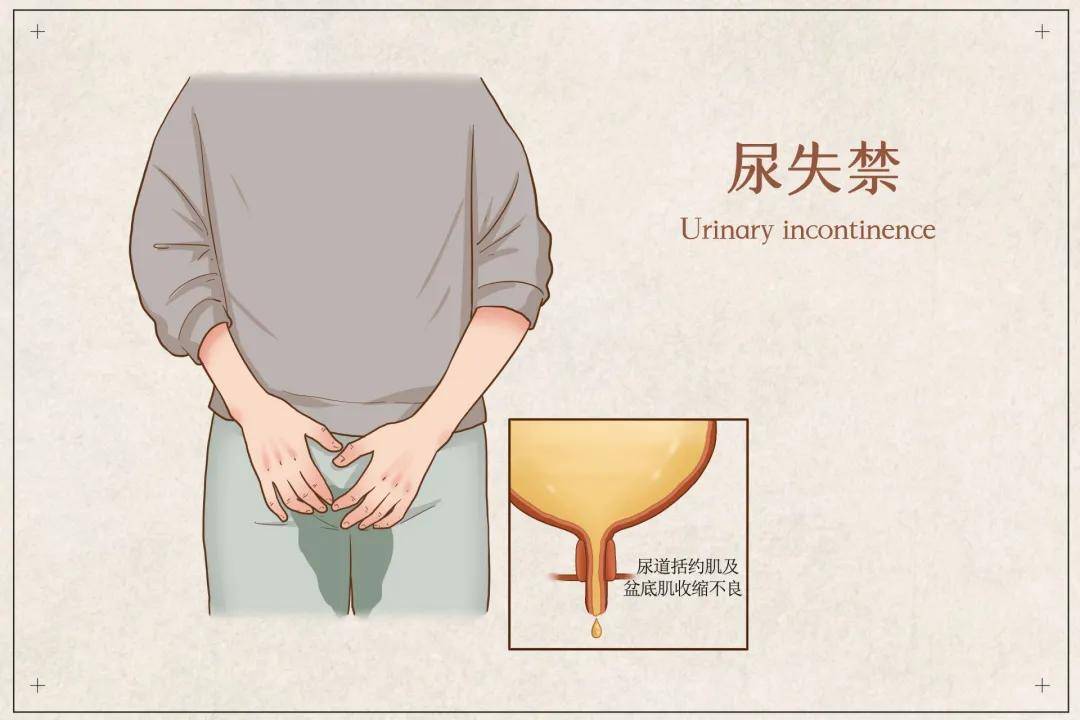 摄图网_401862927_banner_尿失禁医疗插画（企业商用）.jpg