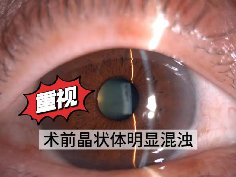 七旬老人在佛山爱尔重获清晰视界,飞秒激光联合三焦点晶体让视力从0.5跃升1.0(图3) 七旬老人在佛山爱尔重获清晰视界,飞秒激光联合三焦点晶体让视力从0.5跃升1.0(图3)