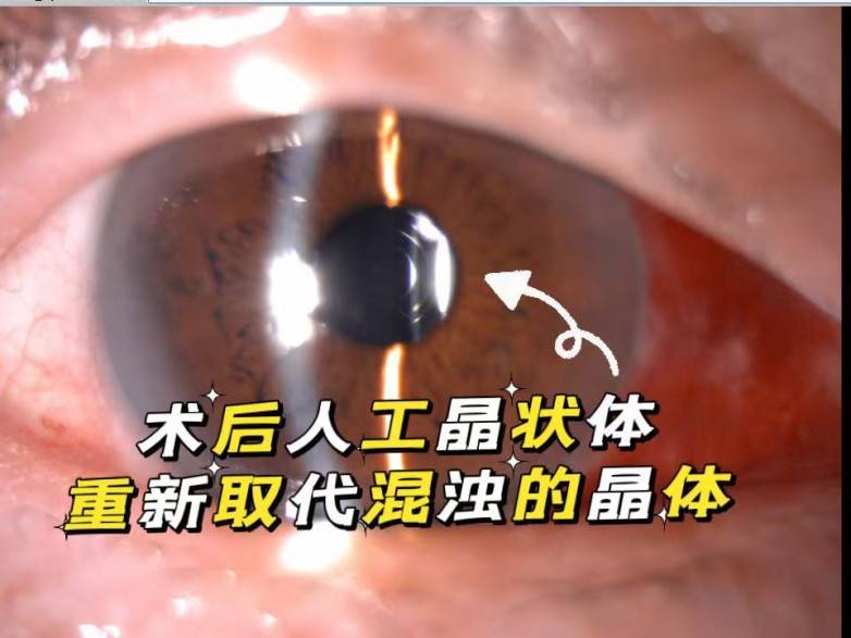 七旬老人在佛山爱尔重获清晰视界,飞秒激光联合三焦点晶体让视力从0.5跃升1.0(图2) 七旬老人在佛山爱尔重获清晰视界,飞秒激光联合三焦点晶体让视力从0.5跃升1.0(图2)