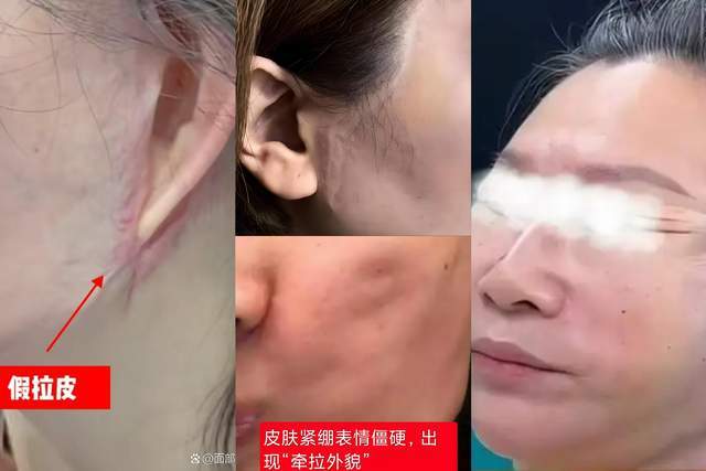 拉皮失败后能做修复吗？魏广运专业解答