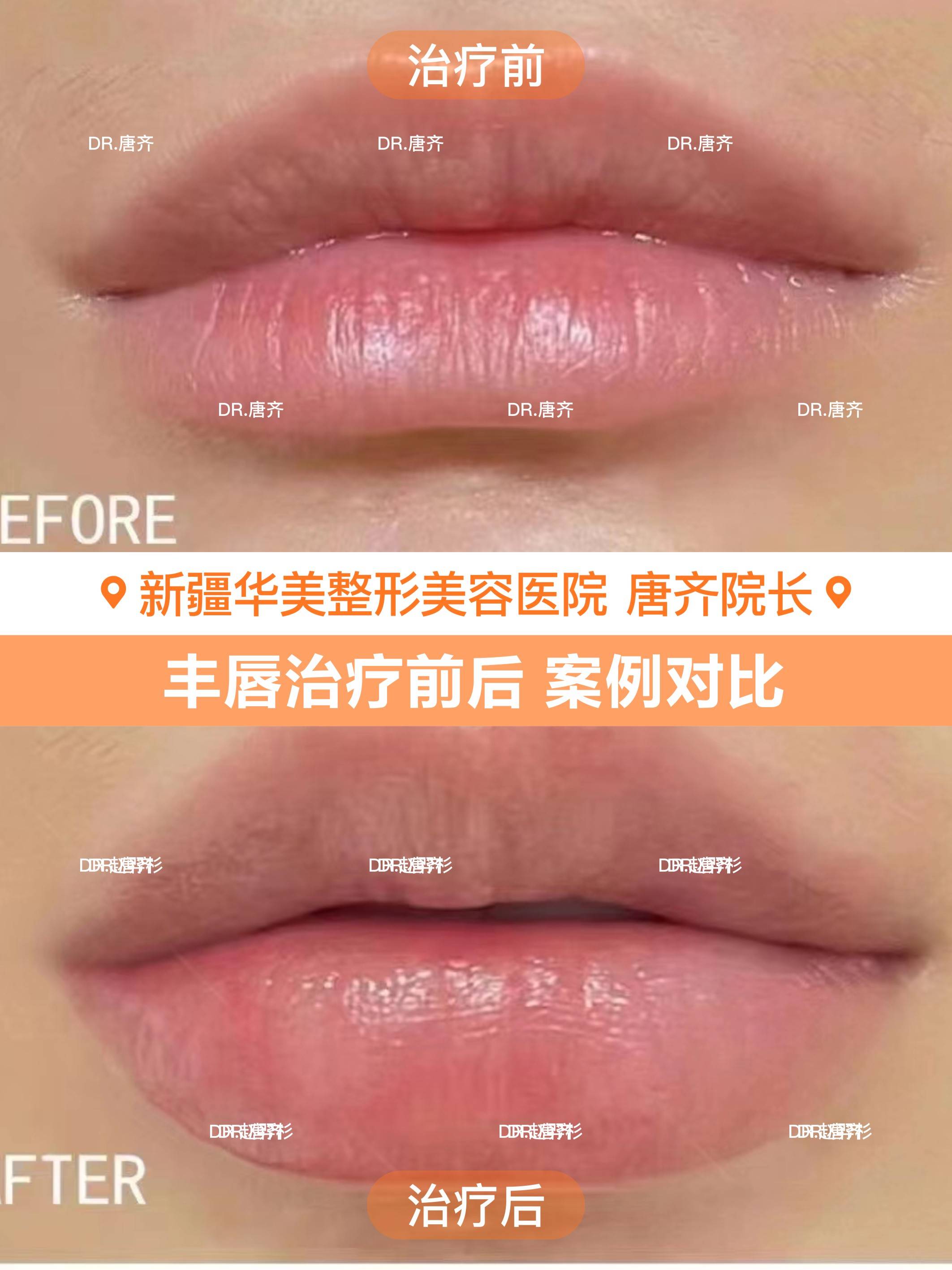瘦肩针注射医师选择参考