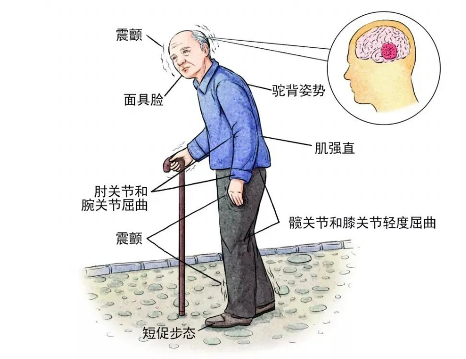 帕金森的病情发展到最后是怎么样