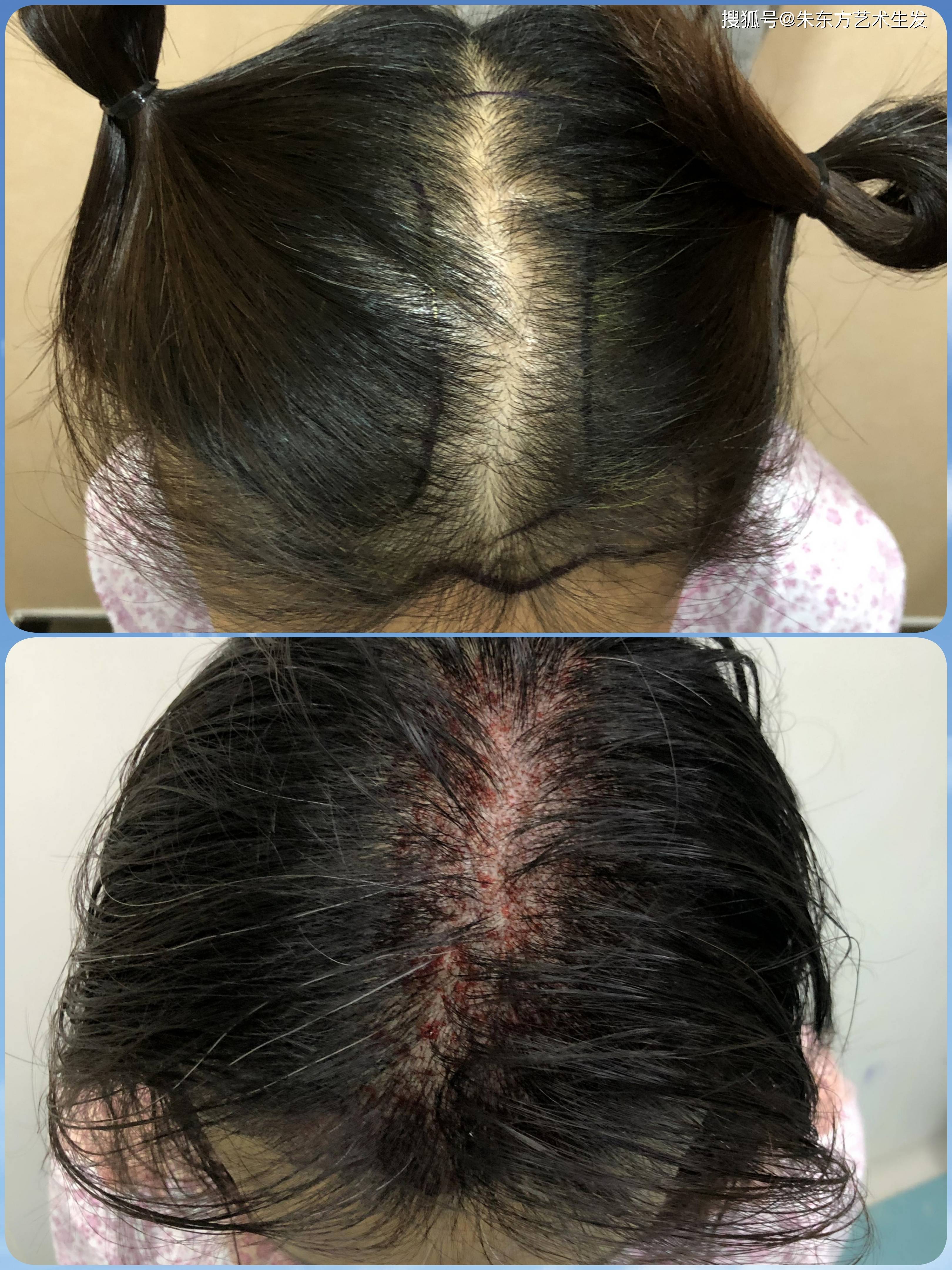女人植发教程视频(女性植发 贴吧)