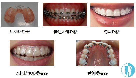 矯正牙齒的步驟和過程_患者_醫生_進行