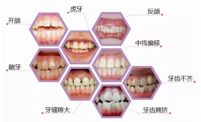 牙齒排列不齊牙周