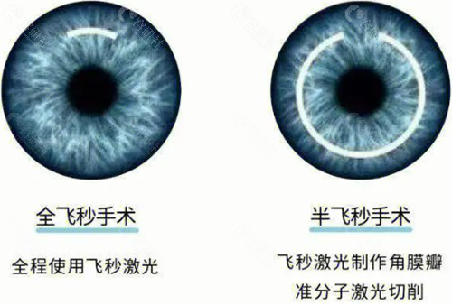 近视手术全飞秒和半飞秒都可该如何选择