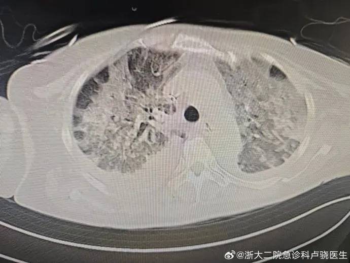 新冠或现感染小高峰?从没阳过的人要当心了!_症状_胡必杰_病毒