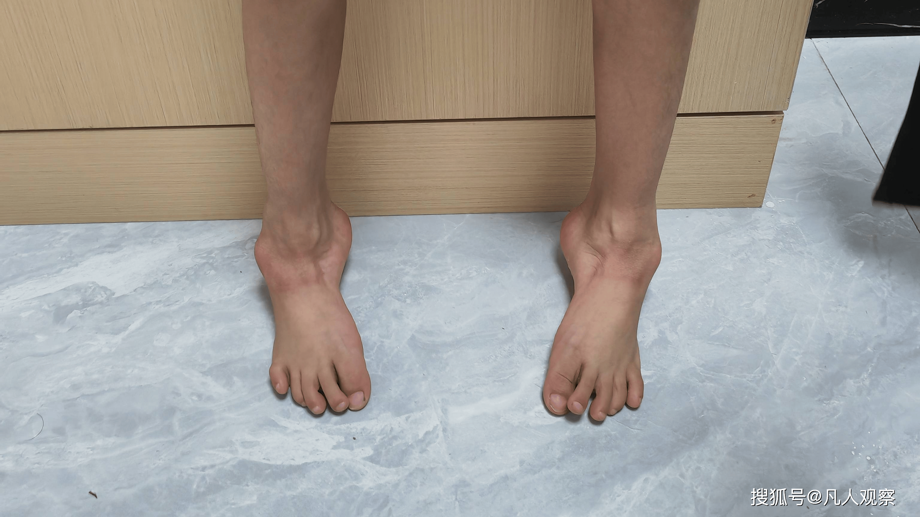 菏泽黄河骨科医院成功实施矫形手术助力后天性马蹄内翻足儿童重获健康