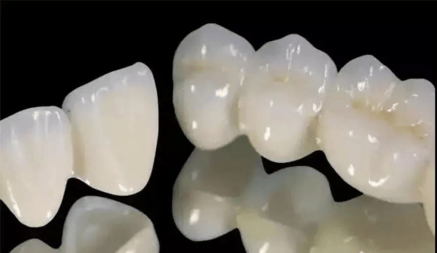 宏皓口腔医院-全瓷冠金属牙冠通常由不锈钢,钴铬合金或贵金属制成.