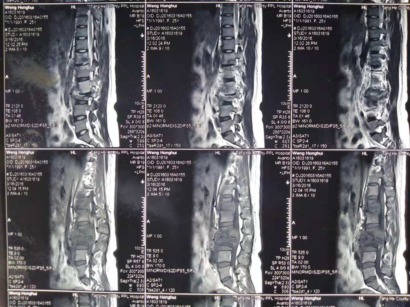 南阳骨结核中药研发中心骨结核从感染到发病要多久