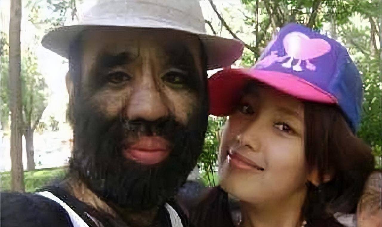 原创当年轰动一时的毛孩42岁娶90后娇妻生下一子未遗传长毛