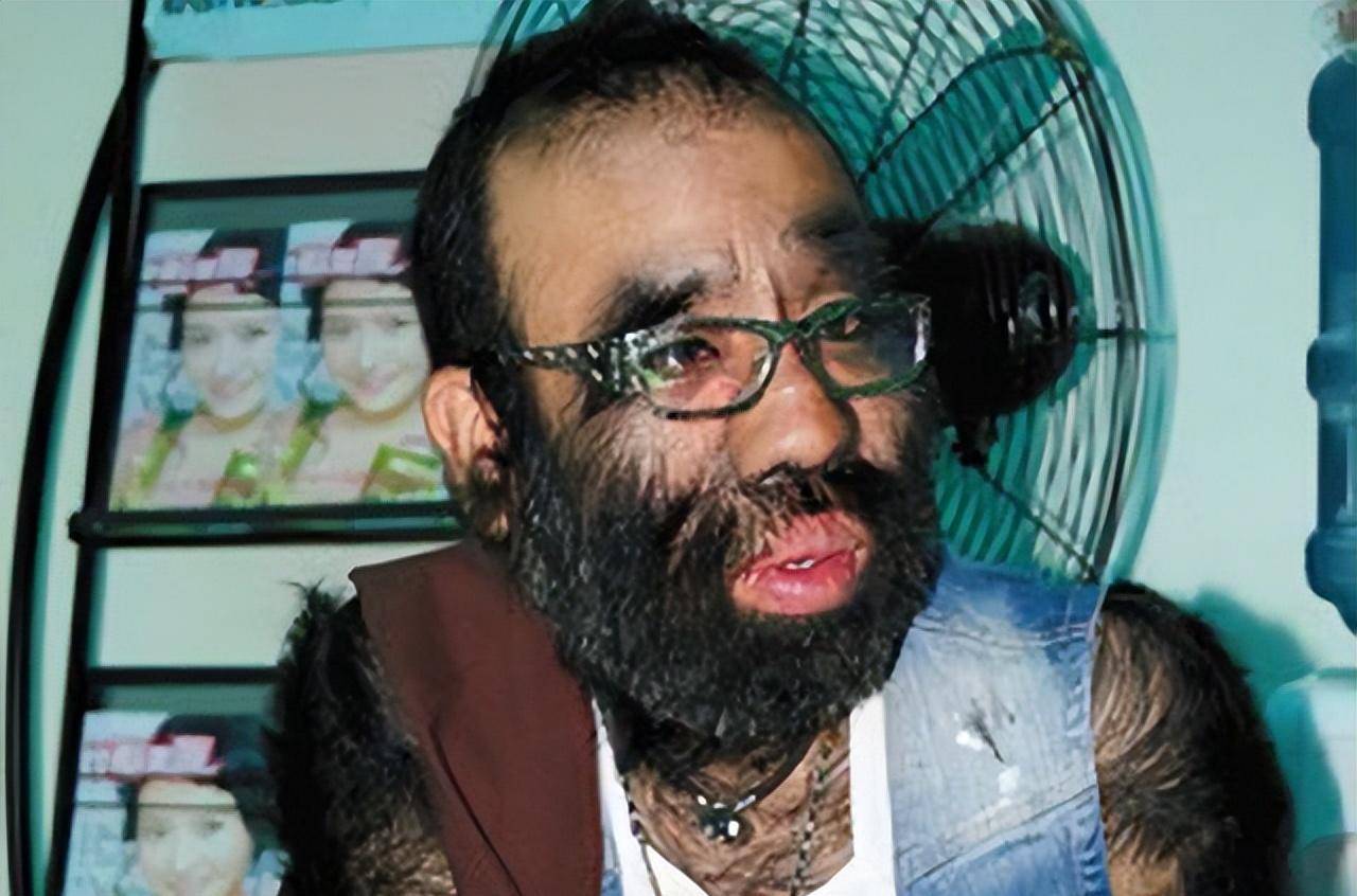 原创当年轰动一时的毛孩42岁娶90后娇妻生下一子未遗传长毛