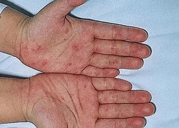 乙型肝炎跟糖尿病也有关