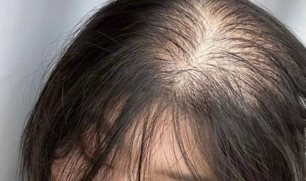 还好没放弃!发缝宽发际线上移终于解决了!方法大家一定要知道!