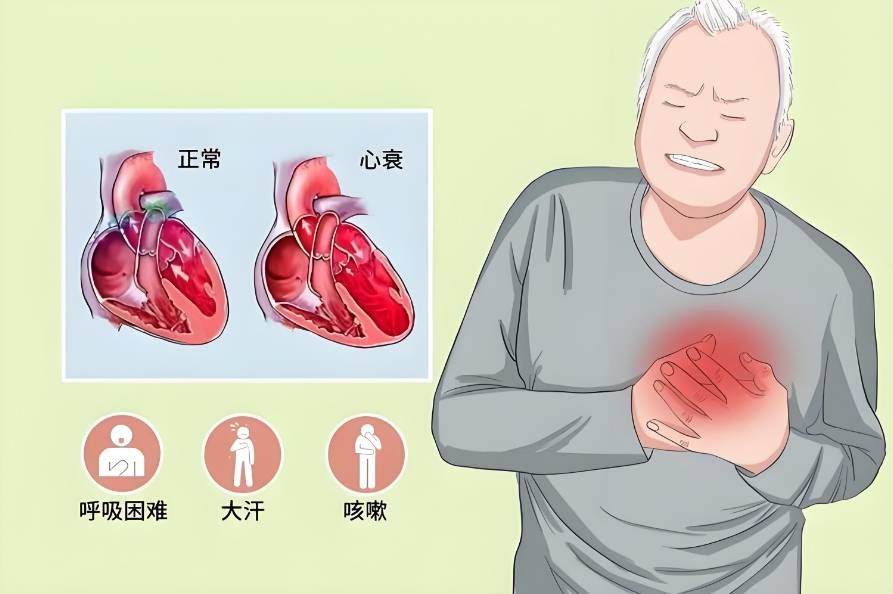 心衰的急救方法概述