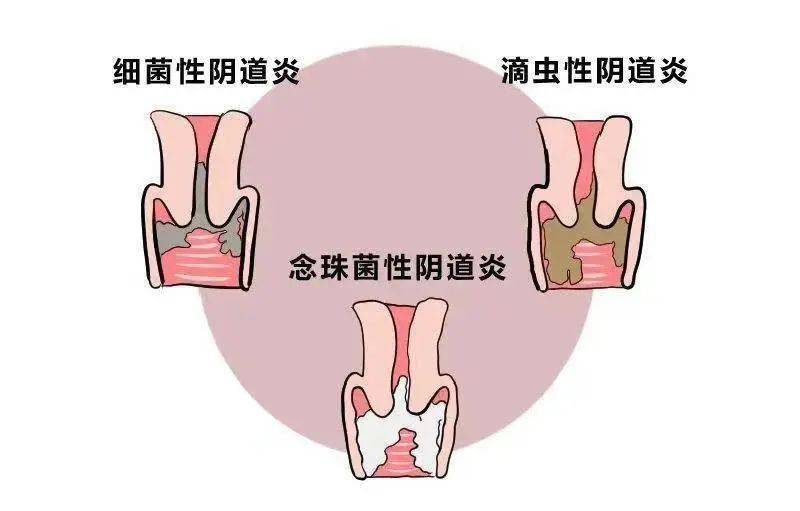 杭州新城妇儿医院指出,y道原本有自洁功能,如果出现一点外y瘙痒就