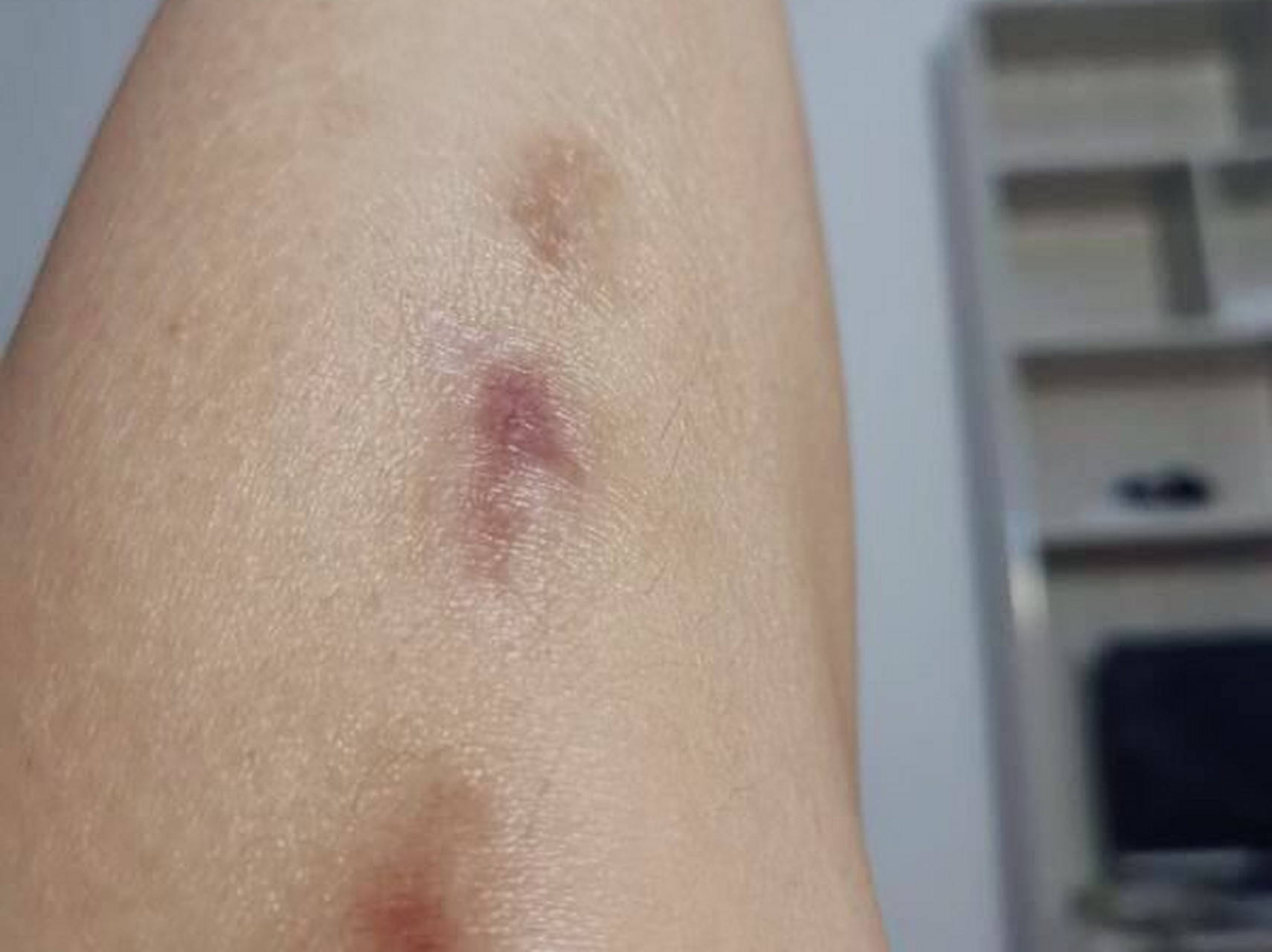 哪些情况打疤痕针会反弹?