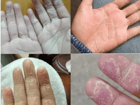 皮肤科专家:过敏性皮炎包含种类较多,治疗时一定要注意!