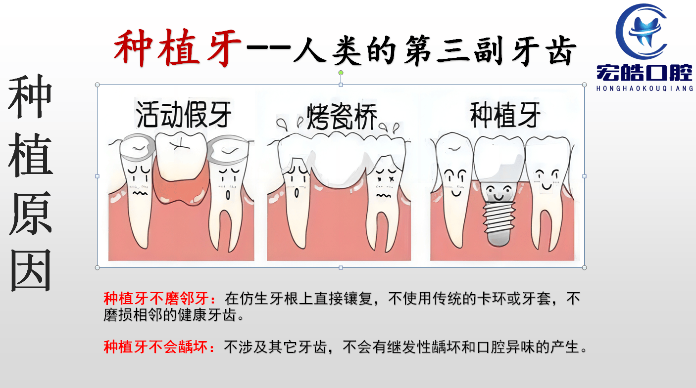 本文将详细探讨种植牙的优势,并介绍邢台宏皓口腔医院在种植