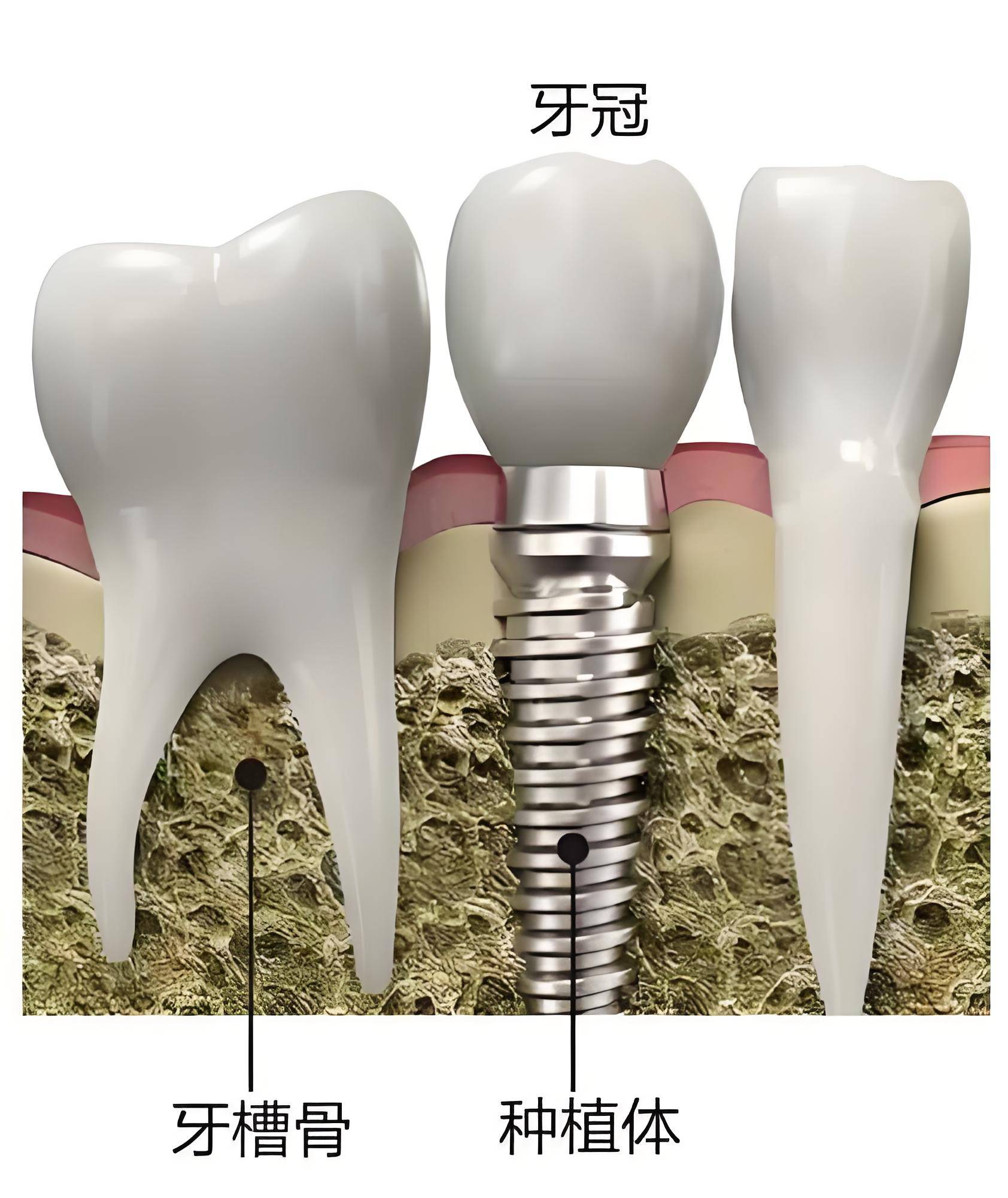 在口腔医学领域,修复牙齿缺失的方法多种多样,其中种植牙和镶牙是