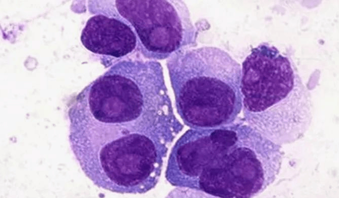 想要活得长久,骨髓瘤病友需要符合这三点!