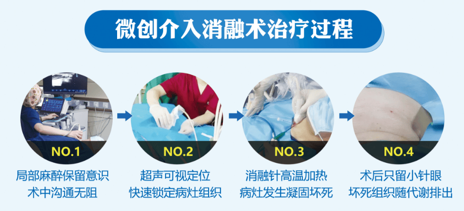 不吃药,不开刀,朝阳门医院甲状腺专科,开创无创治疗新
