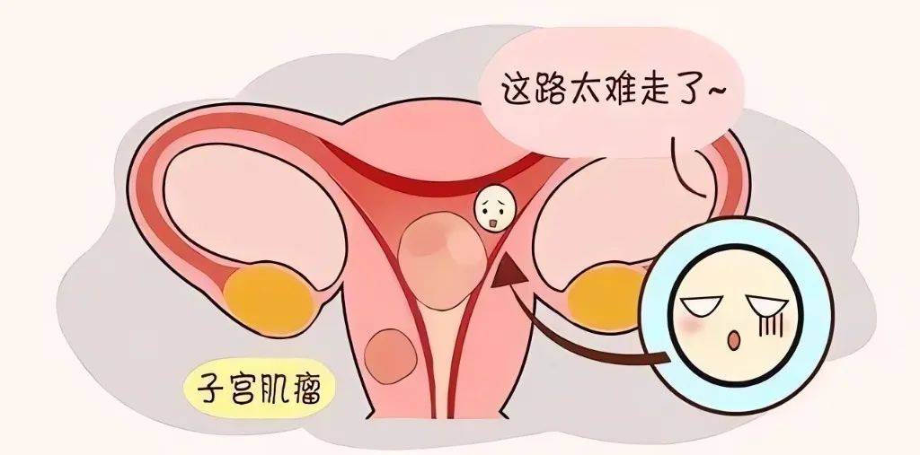揭秘子宫肌瘤的五大元凶:守护女性健康,从了解开始!