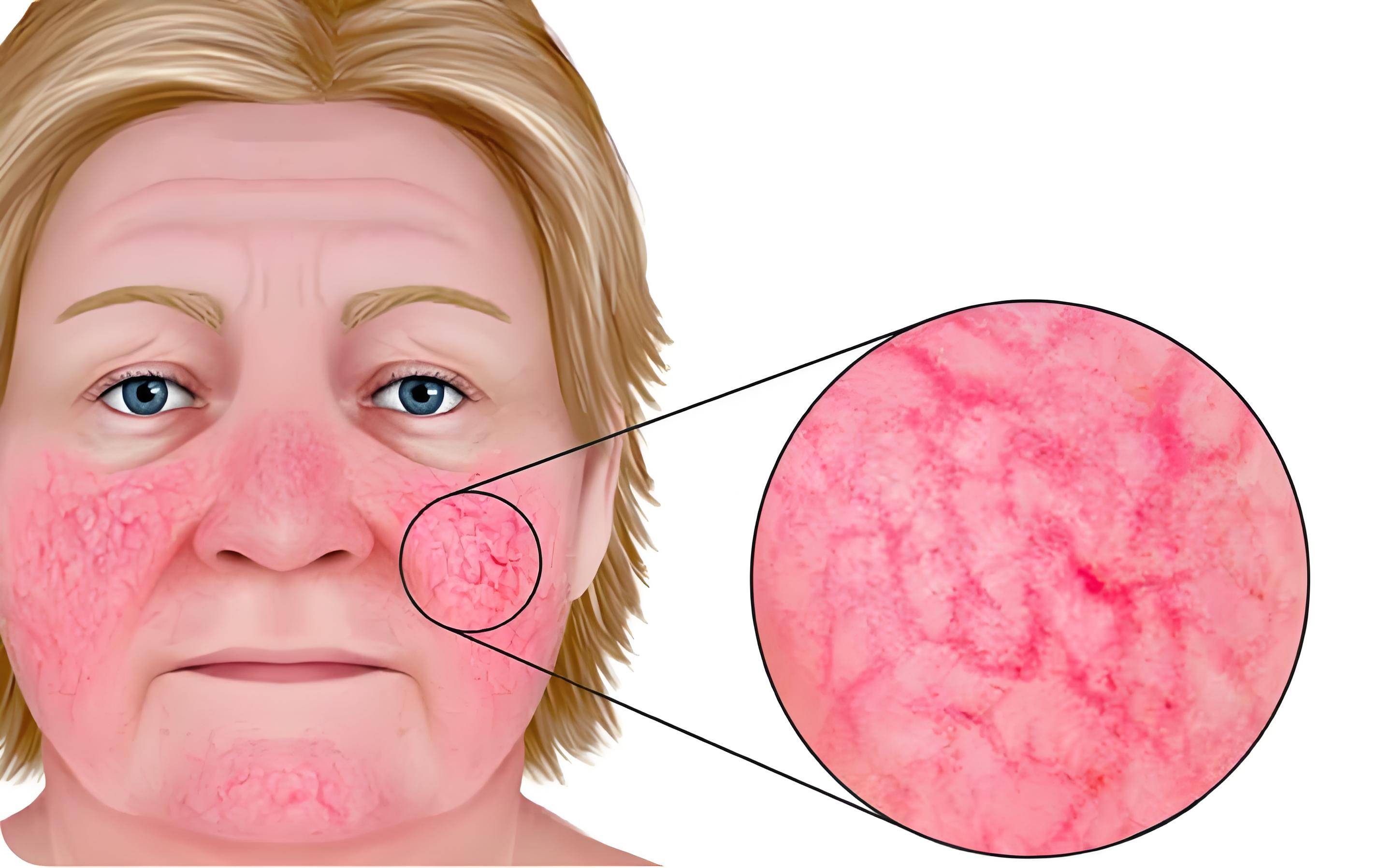 整形皮肤科刘燕燕医生解析玫瑰痤疮:原因,症状和预防措施