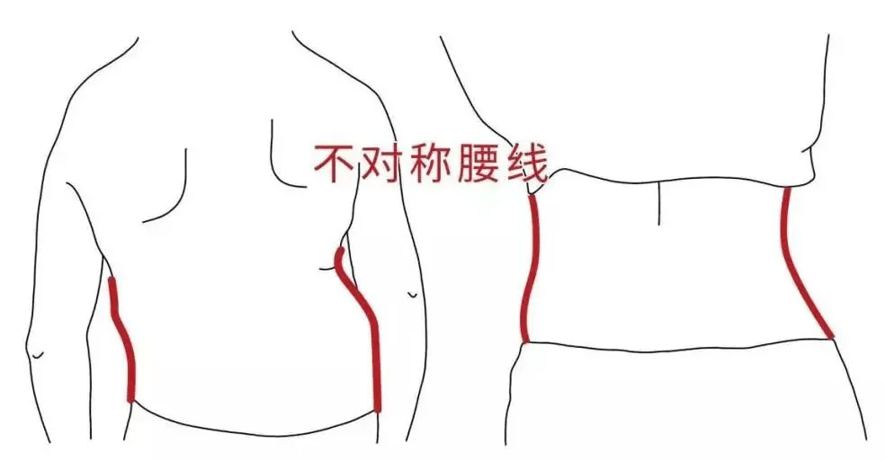 脊柱畸形公益救助:孩子体态有这些异常,暑假来昆明同仁医院看诊