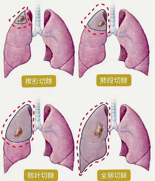 合肥中山医院 小切口里的"大手术"| 胸腔镜微创手术