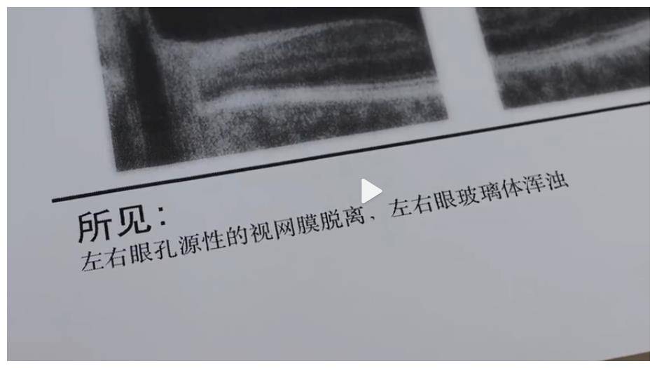 女子滴网红眼药水后视力严重下降,到医院一查:双眼视网膜脱落!