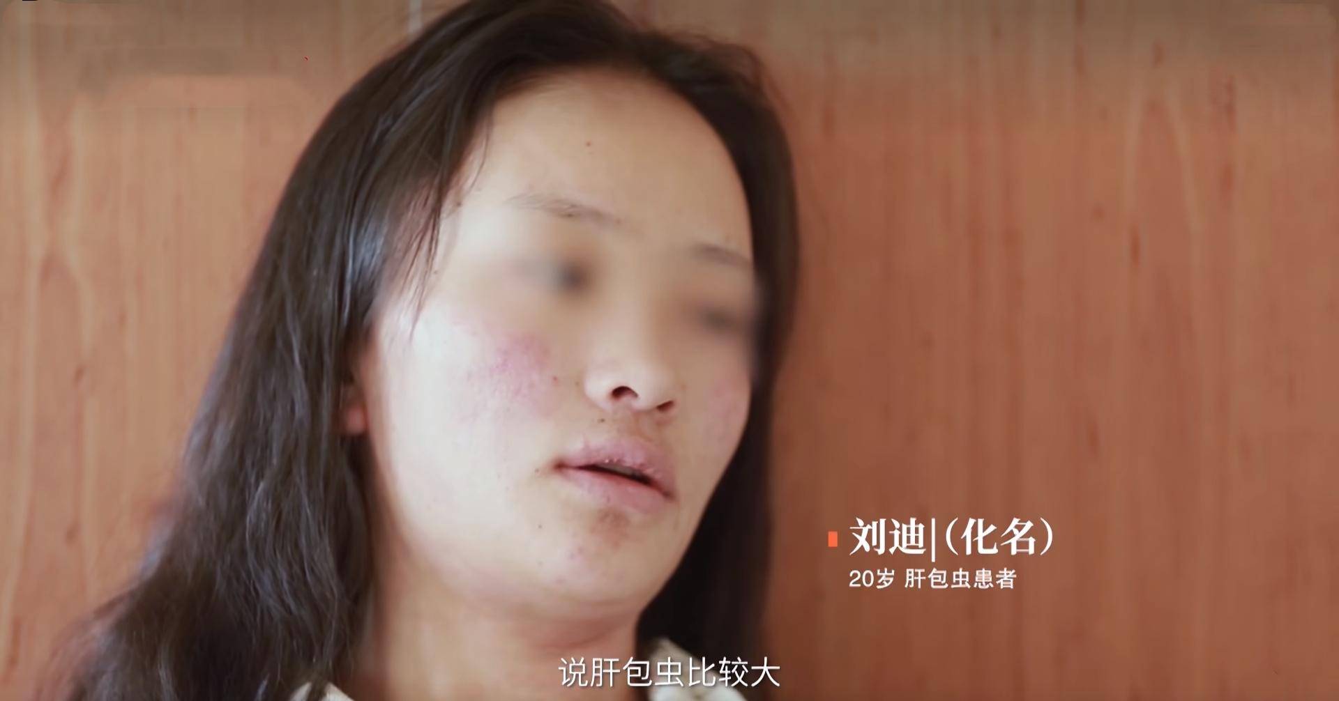 2019年,花季女孩眼珠发黄以为问题不大,医生开刀取出两斤虫子