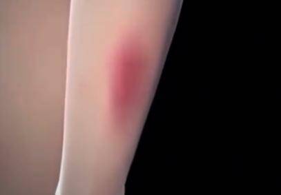原创            女子把隐翅虫当蚊子拍死差点毁容-隐翅虫被拍死