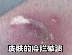 原创            女子把隐翅虫当蚊子拍死差点毁容-隐翅虫被拍死