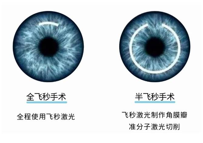 全飞秒激光近视手术
